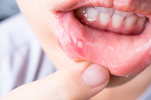 Why Am I Suffering From Mouth Ulcers During Pregnancy?