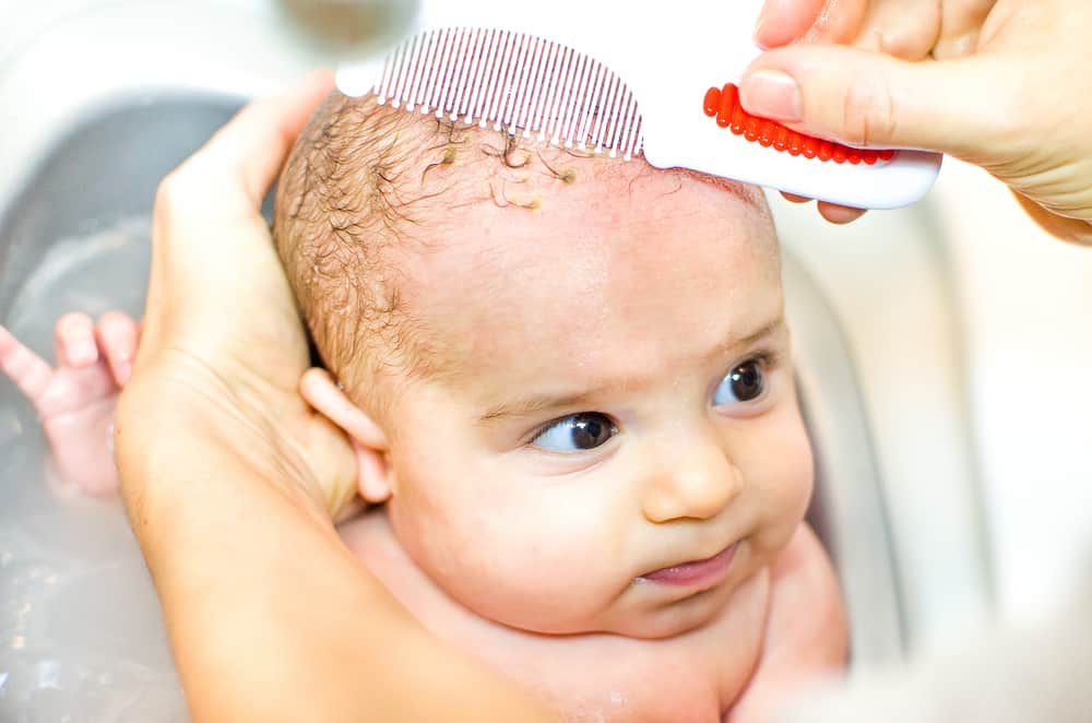 Baby with cradle cap