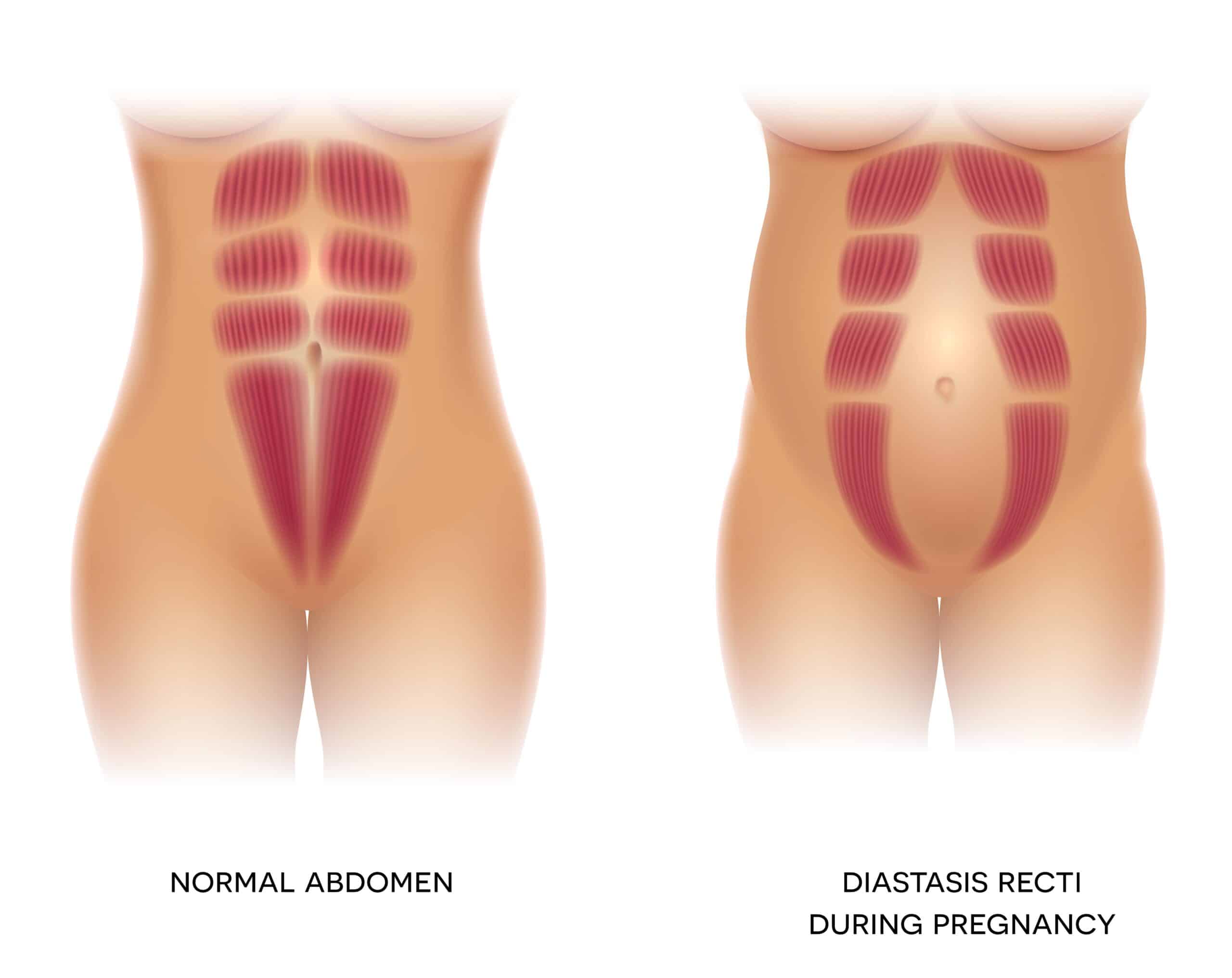 diagram of diastasis recti normal abdomen vs. during pregnancy