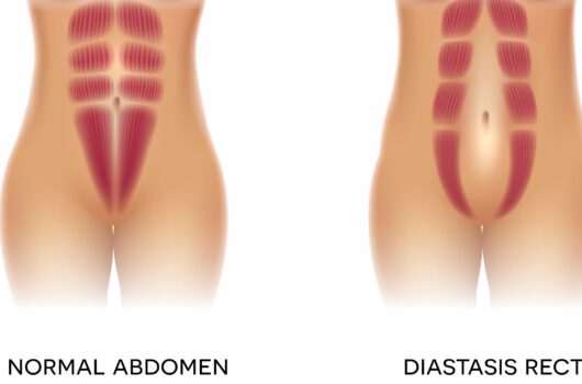 How to Prevent Diastasis Recti and Snap Back After Pregnancy