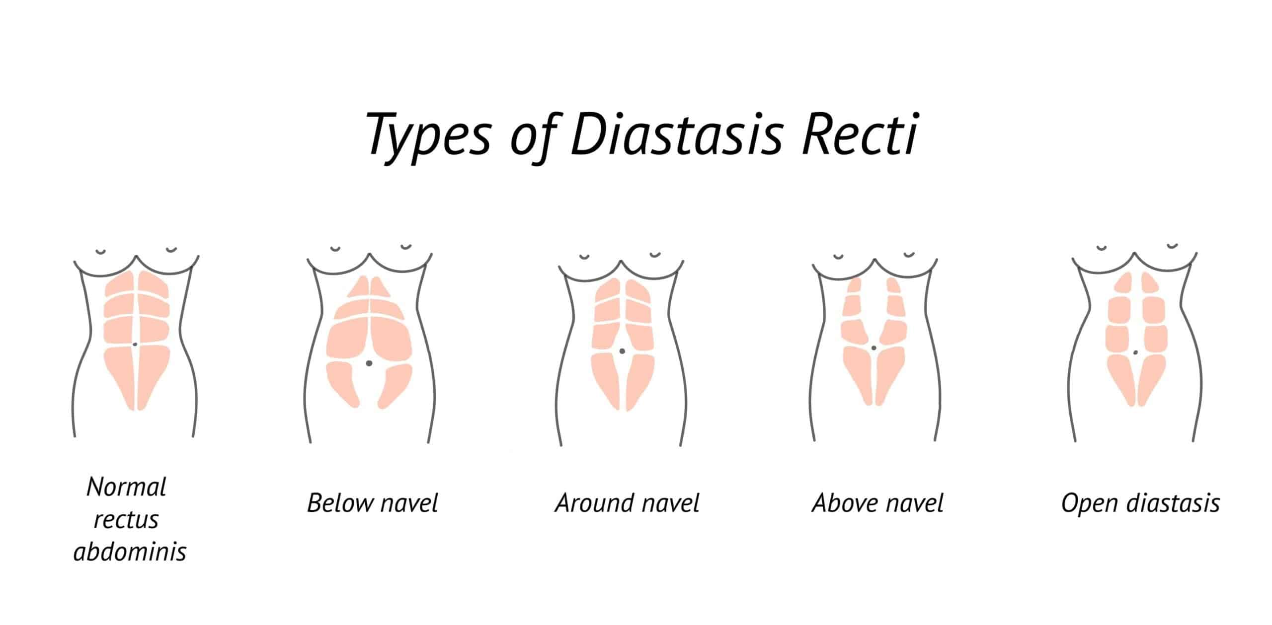 types of diastasis recti